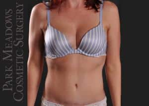 After Image: Abdominoplasty, Liposuction of Abdomen, Flanks, & Back - front