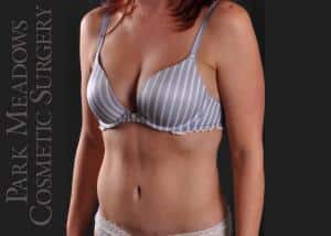 After Image: Abdominoplasty, Liposuction of Abdomen, Flanks, & Back - left-front-oblique