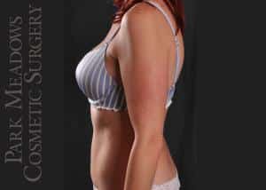 After Image: Abdominoplasty, Liposuction of Abdomen, Flanks, & Back - left-side