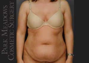 Before Image: Abdominoplasty, Liposuction of Abdomen, Flanks, & Back - front