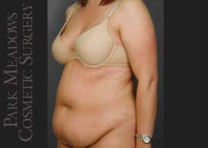 Before Image: Abdominoplasty, Liposuction of Abdomen, Flanks, & Back - left-front-oblique