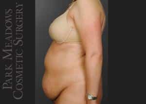 Before Image: Abdominoplasty, Liposuction of Abdomen, Flanks, & Back - left-side