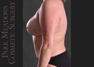After Image: Abdominoplasty, Liposuction of Flanks, Truck, Abdomen, and Back; Breast Lift with 400 cc Silicone Implants - left-side