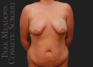 Before Image: Abdominoplasty, Liposuction of Flanks, Truck, Abdomen, and Back; Breast Lift with 400 cc Silicone Implants - front
