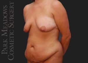Before Image: Abdominoplasty, Liposuction of Flanks, Truck, Abdomen, and Back; Breast Lift with 400 cc Silicone Implants - left-front-oblique