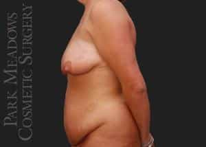 Before Image: Abdominoplasty, Liposuction of Flanks, Truck, Abdomen, and Back; Breast Lift with 400 cc Silicone Implants - left-side
