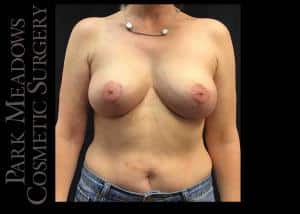 After Image: Bilateral Complete and Total Capsulectomy; Bilateral Implant Removal; Bilateral Mastopexy - front