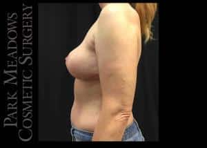 After Image: Bilateral Complete and Total Capsulectomy; Bilateral Implant Removal; Bilateral Mastopexy - left-side
