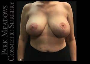 Before Image: Bilateral Complete and Total Capsulectomy; Bilateral Implant Removal; Bilateral Mastopexy - front