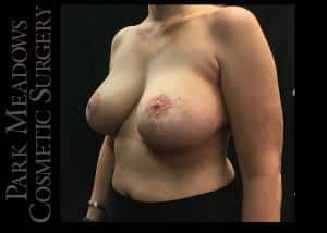 Before Image: Bilateral Complete and Total Capsulectomy; Bilateral Implant Removal; Bilateral Mastopexy - left-front-oblique