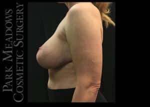 Before Image: Bilateral Complete and Total Capsulectomy; Bilateral Implant Removal; Bilateral Mastopexy - left-side