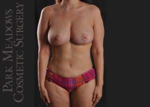 Liposuction of Abdomen & Flanks, Inner & Outer Thighs; Breast Reduction