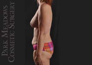 After Image: Liposuction of Abdomen & Flanks, Inner & Outer Thighs; Breast Reduction - left-side