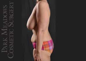 Before Image: Liposuction of Abdomen & Flanks, Inner & Outer Thighs; Breast Reduction - left-side