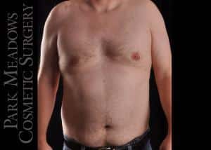 Gynecomastia Surgery with Direct Excision