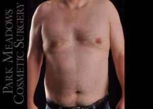 After Image: Gynecomastia Surgery with Direct Excision - front