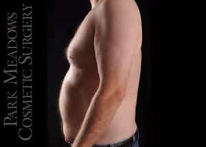 After Image: Gynecomastia Surgery with Direct Excision - left-side
