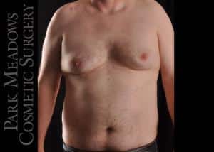 Before Image: Gynecomastia Surgery with Direct Excision - front