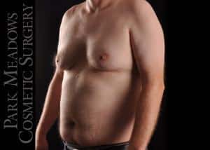 Before Image: Gynecomastia Surgery with Direct Excision - left-front-oblique