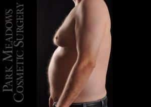 Before Image: Gynecomastia Surgery with Direct Excision - left-side