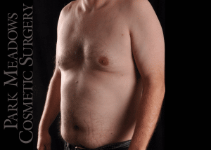 After Image: Gynecomastia Surgery with Direct Excision - left-front-oblique