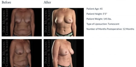 before and after Tummy Tuck Highlands Ranch CO