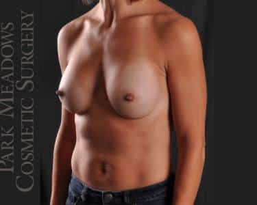 After Image: Silicone Breast Augmentation ; 300 cc Silicone Implants - left-front-oblique