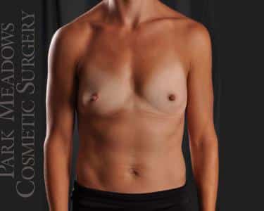 Before Image: Silicone Breast Augmentation ; 300 cc Silicone Implants - front