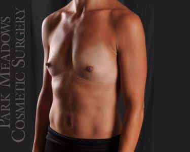 Before Image: Silicone Breast Augmentation ; 300 cc Silicone Implants - left-front-oblique