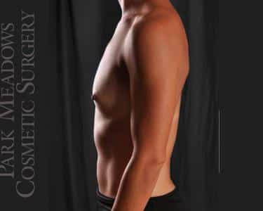 Before Image: Silicone Breast Augmentation ; 300 cc Silicone Implants - left-side