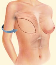 Autologous breast reconstruction Treatment CO
