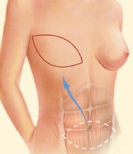 topless female torso during DIEP flap procedure showing stomach tissue being removed with abdominal muscles behind