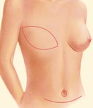 illustration of topless female torso after DIEP flap reconstruction surgery showing breast after fat has been moved from stomach to breast