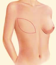 Autologous breast reconstruction Surgery Highlands Ranch CO