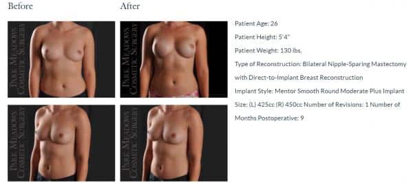 topless female patient before and after bilateral nipple-sparing mastectomy with direct to implant breast reconstruction