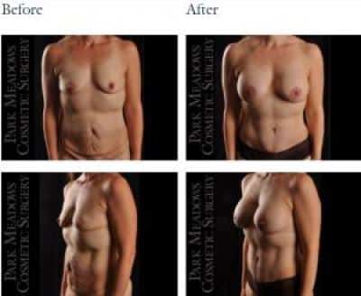 before and after mommy makeover Highlands Ranch CO