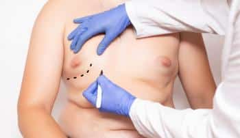 male liposuction Highlands Ranch CO