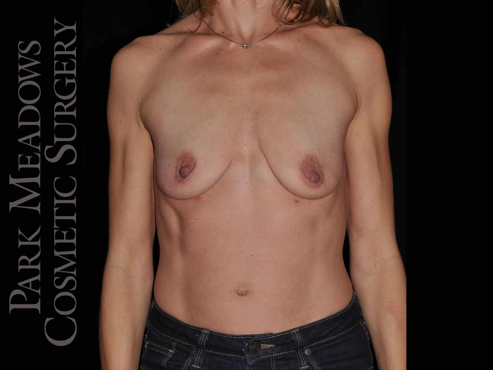 Before Image: Silicone Breast Augmentation - front