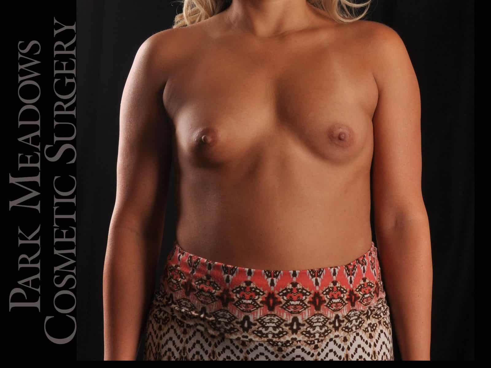 Before Image: Silicone Breast Augmentation - front