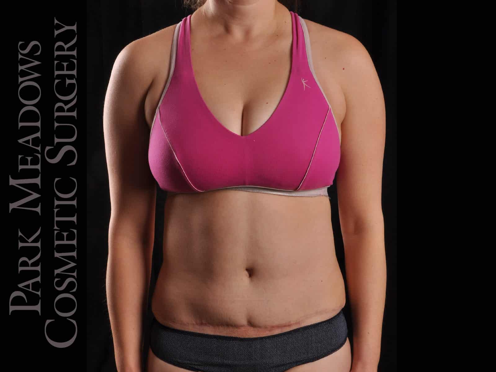 After Image: Abdominoplasty with Liposuction - front