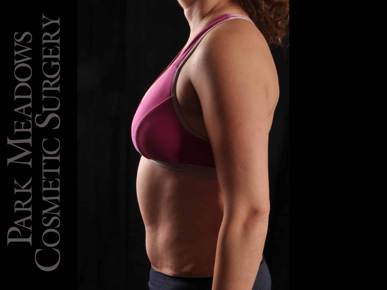 After Image: Abdominoplasty with Liposuction - left-side