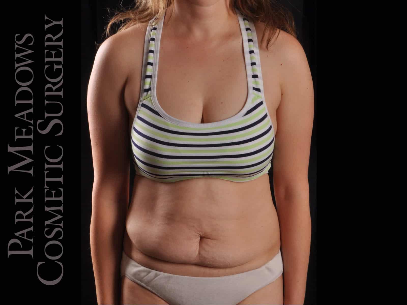 Before Image: Abdominoplasty with Liposuction - front