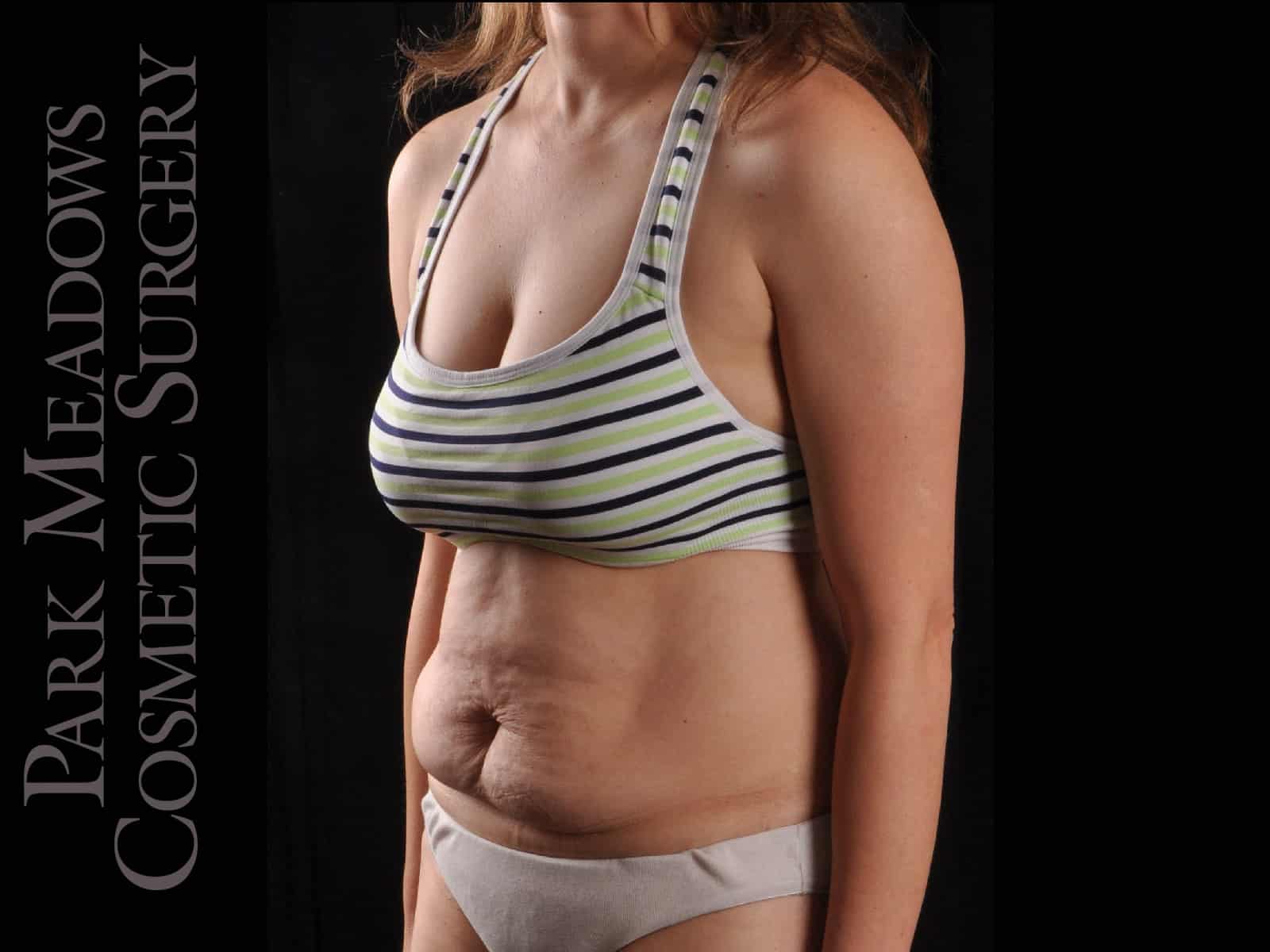 Before Image: Abdominoplasty with Liposuction - left-front-oblique