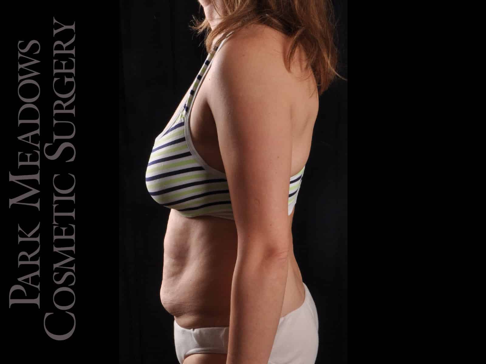 Before Image: Abdominoplasty with Liposuction - left-side