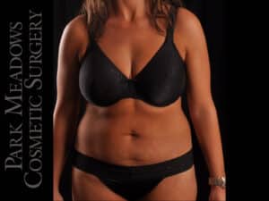 Abdominoplasty with Liposuction