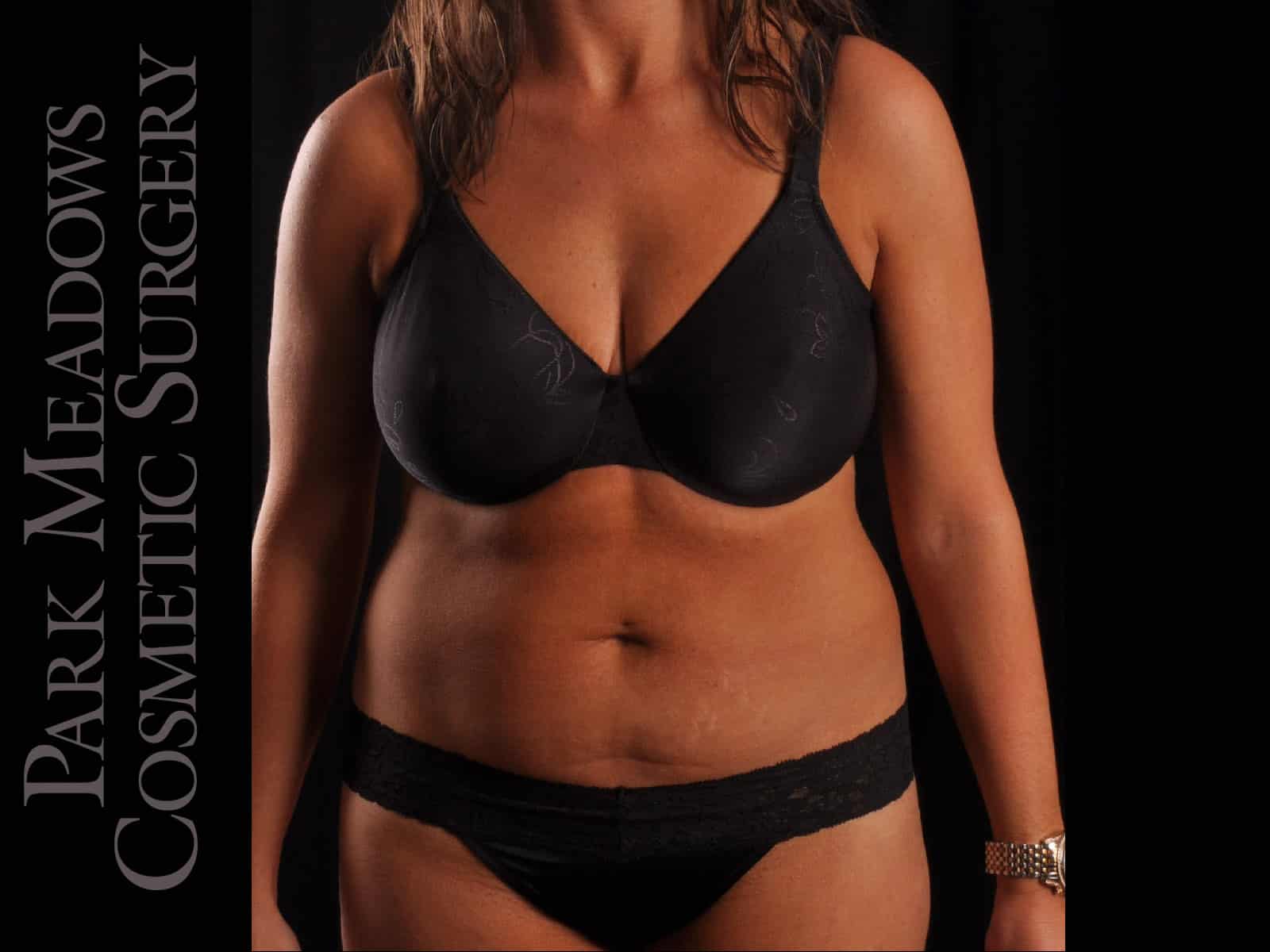 Before Image: Abdominoplasty with Liposuction - front