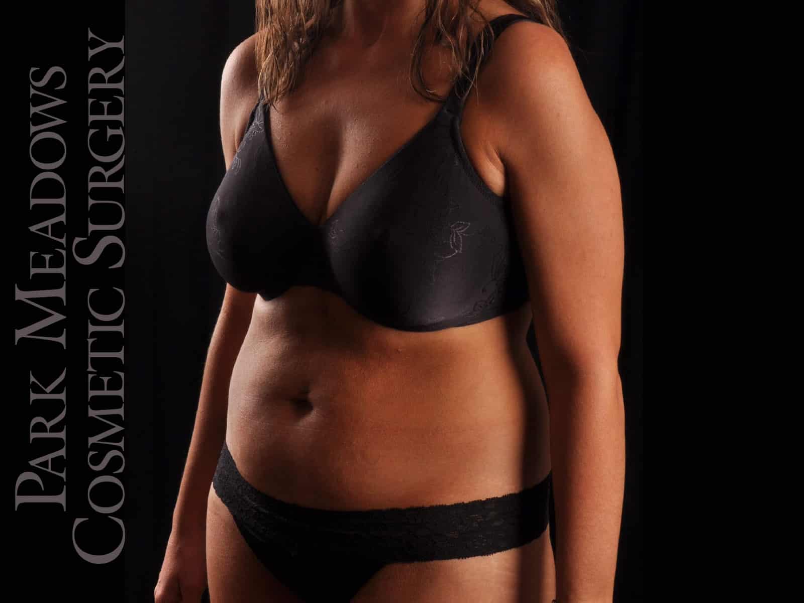 Before Image: Abdominoplasty with Liposuction - left-front-oblique