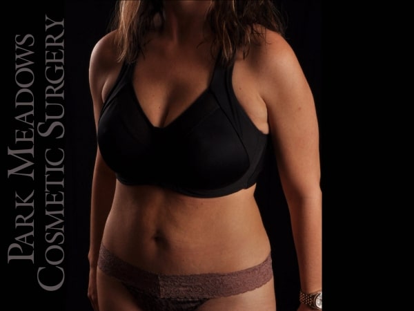 After Image: Abdominoplasty with Liposuction - left-front-oblique