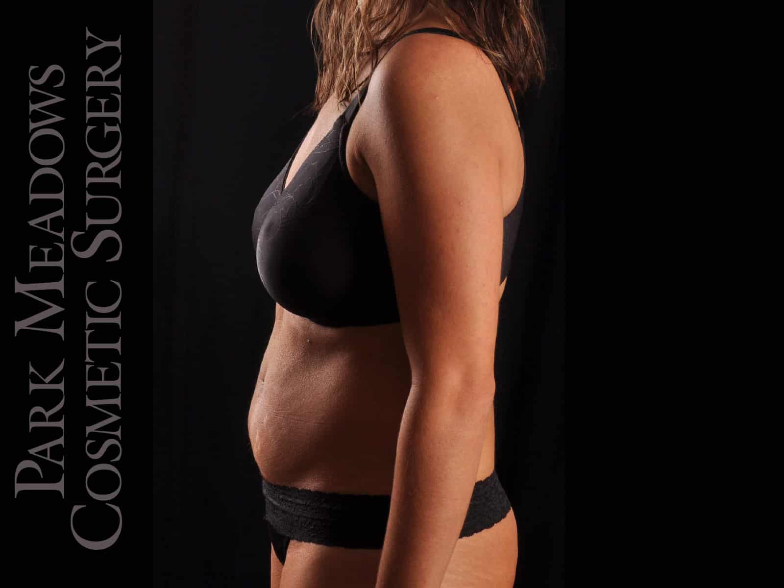 Before Image: Abdominoplasty with Liposuction - left-side