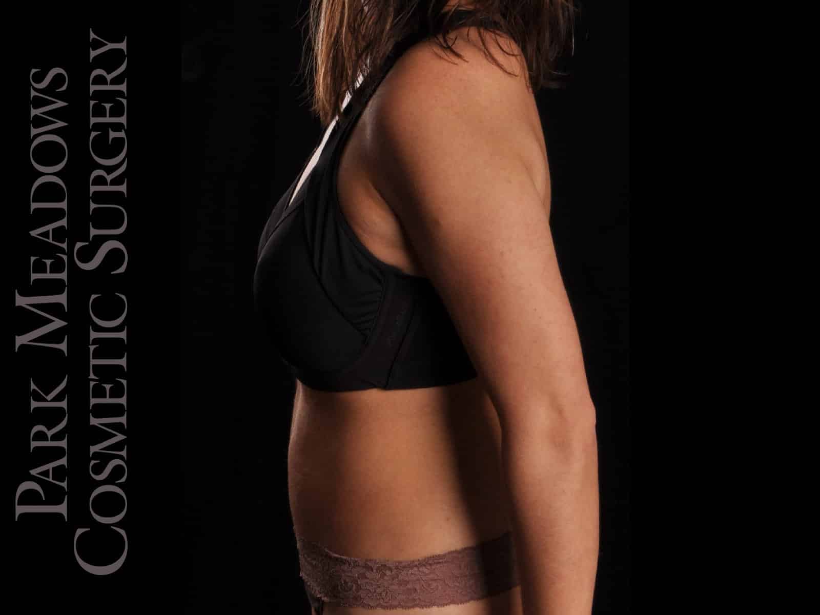 After Image: Abdominoplasty with Liposuction - left-side